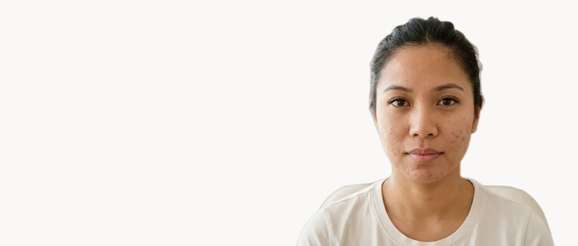 Acne & Breakouts treatment in Pickering