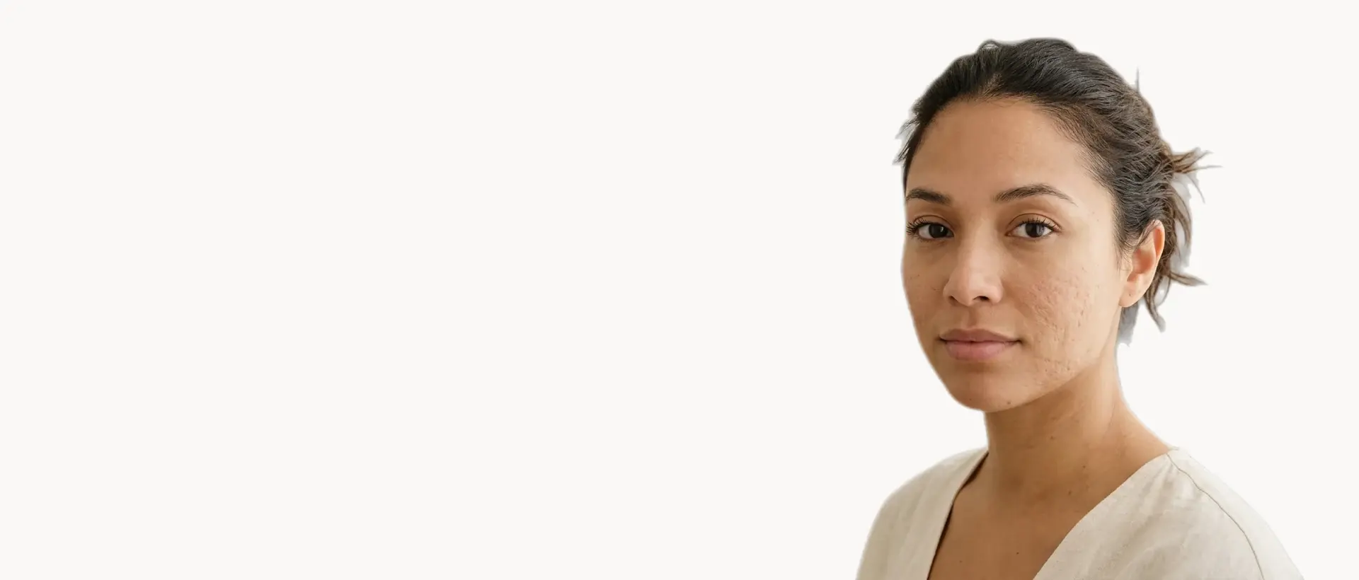Acne Scars treatment in Pickering