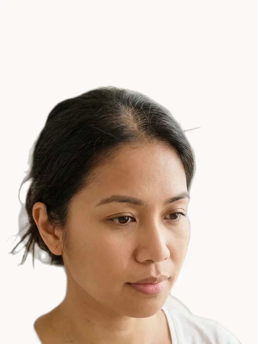 Hair Loss treatment in Pickering