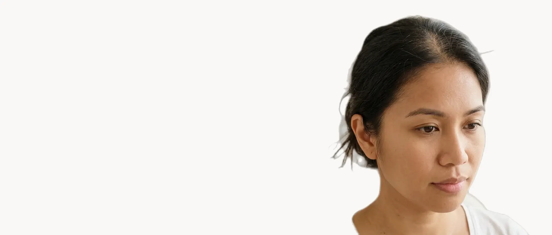Hair Loss treatment in Pickering