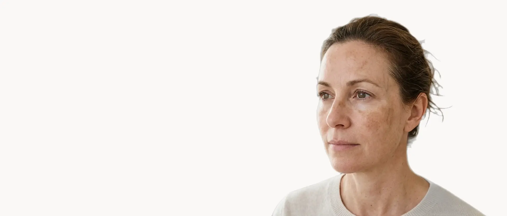 Melasma treatment in Pickering