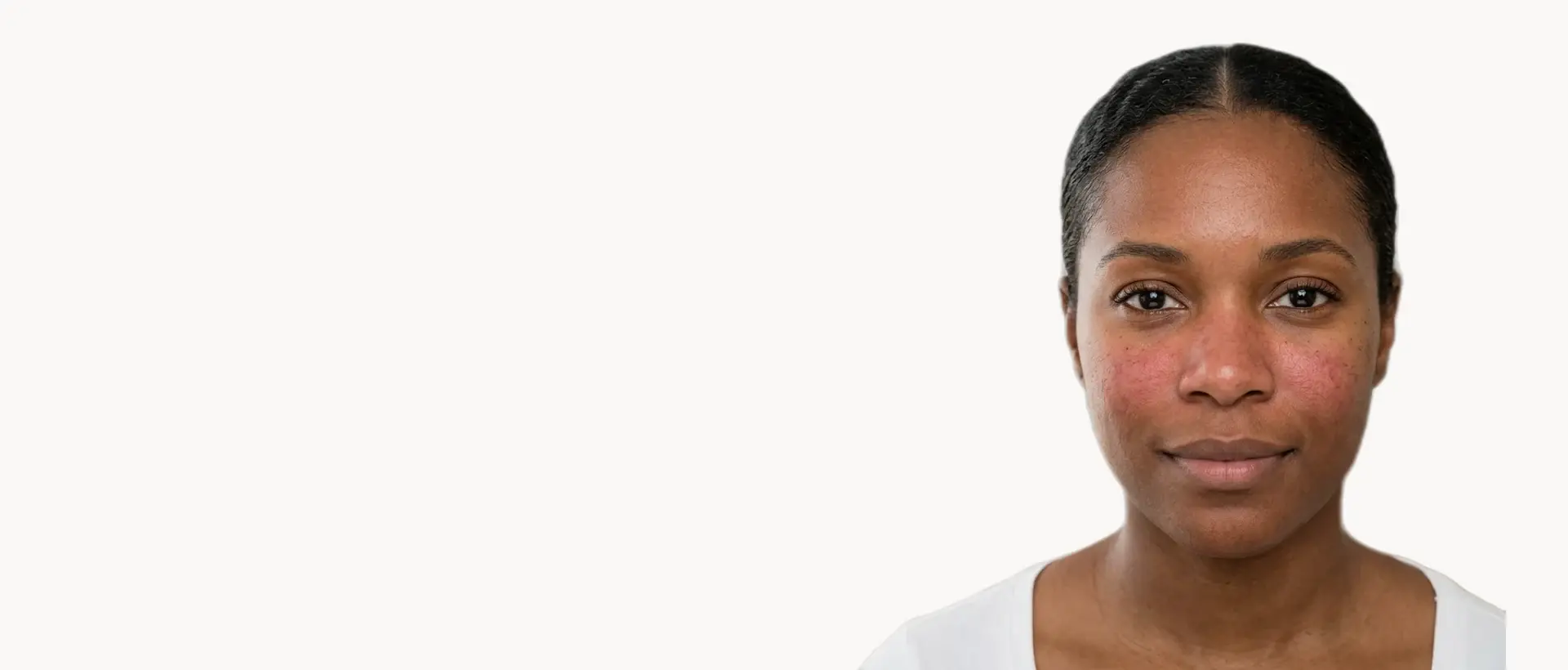 Rosacea treatment in Pickering