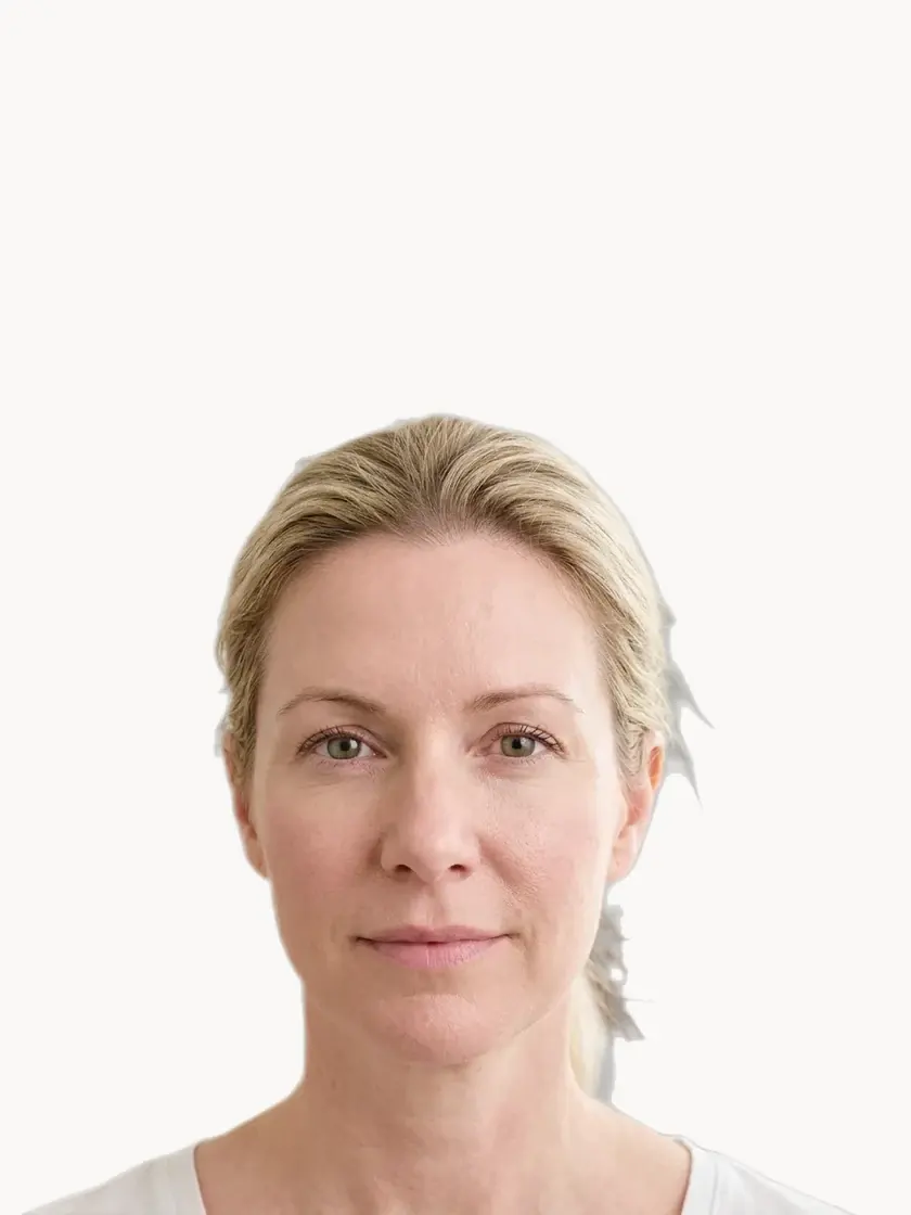 Skin Texture & Enlarged Pores treatment in Pickering