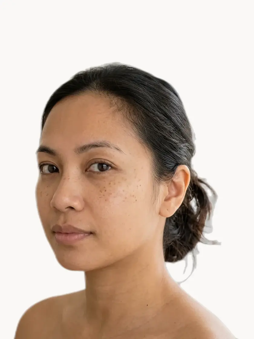 Sun Damage treatment in Pickering