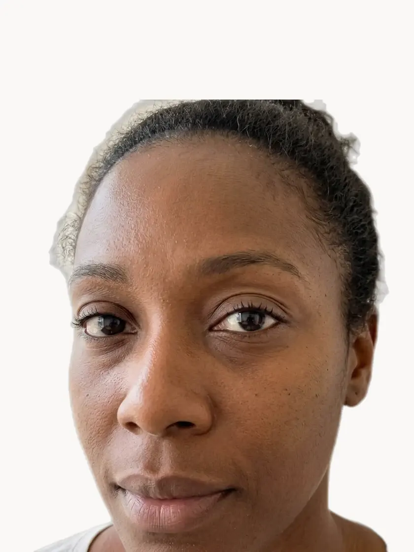 Under-Eye Bags & Dark Circles treatment in Pickering