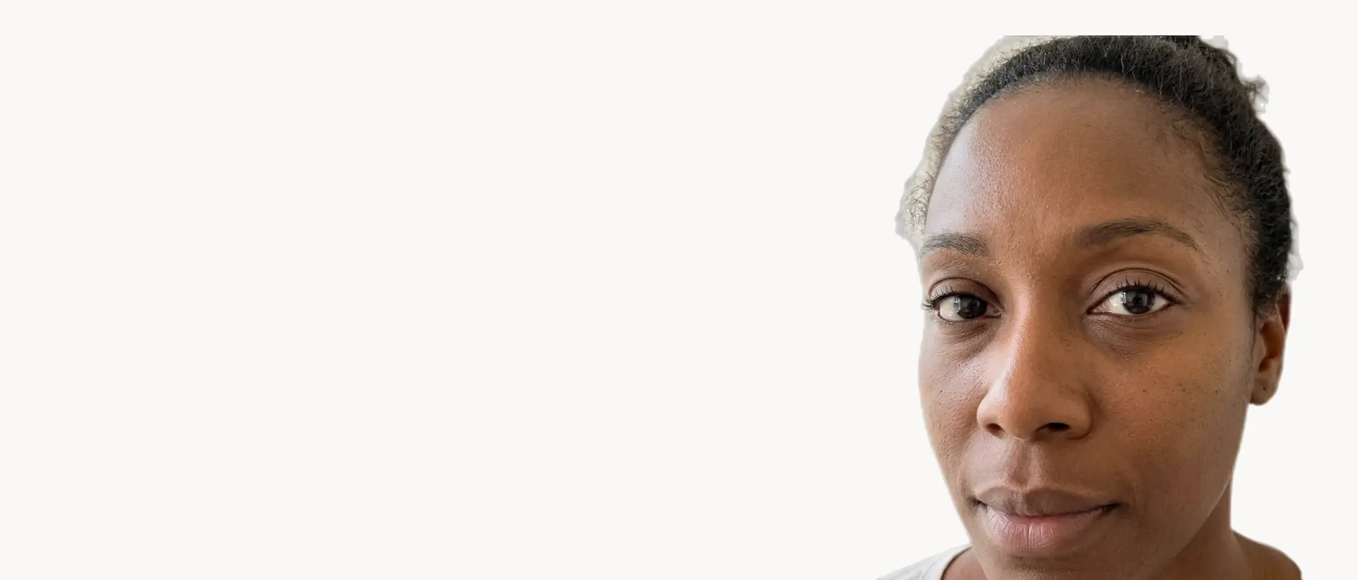 Under-Eye Bags & Dark Circles treatment in Pickering