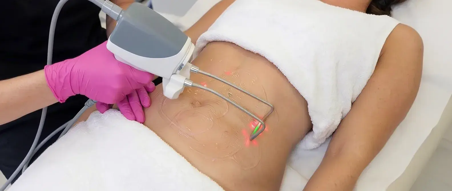 fotona tightsculpting pickering
