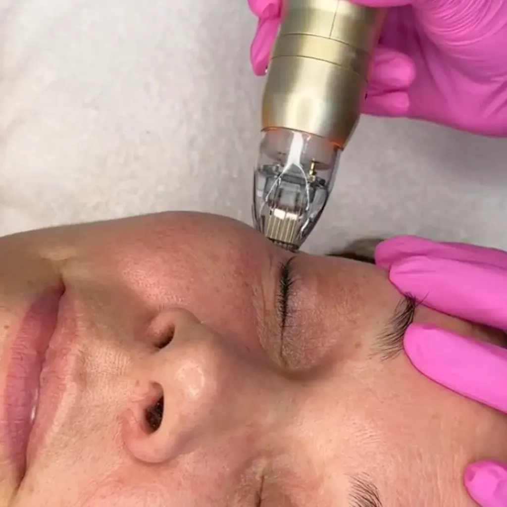 RF Microneedling