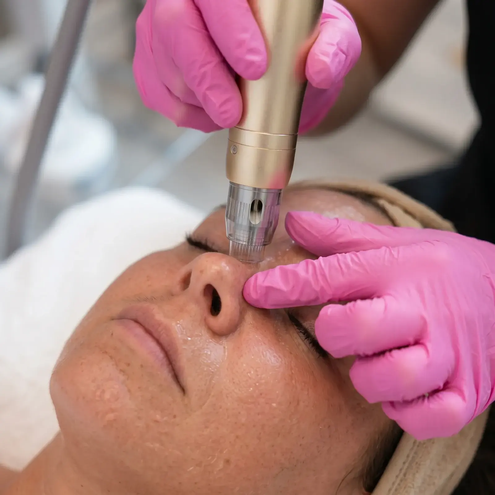 RF Microneedling