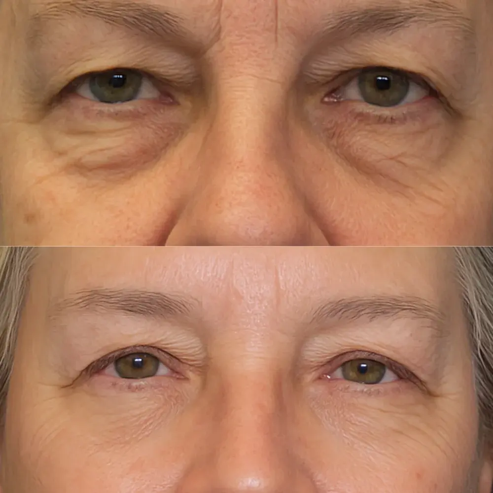 sylfirm x rf microneedling pickering before and after